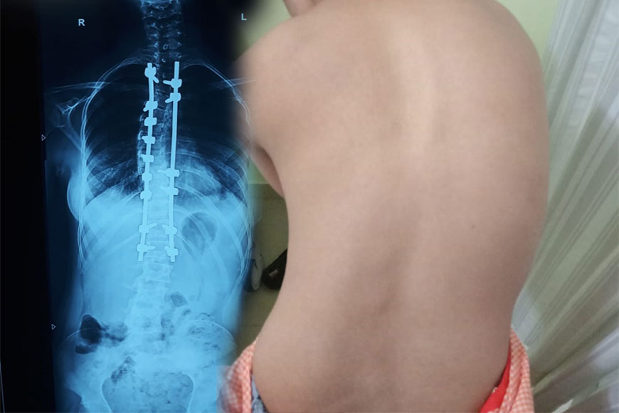  Institute of Neurosciences sets milestone! Rare operation on Scoliosis patient 