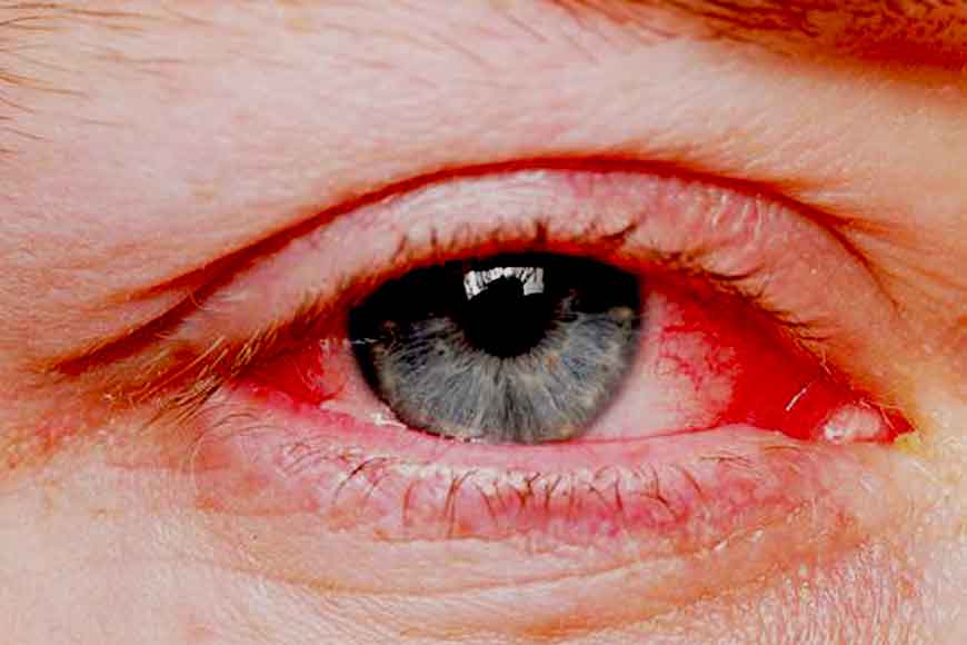 Blood Shot eyes, rupture of blood vessels, new monsoon disease hits Kolkata