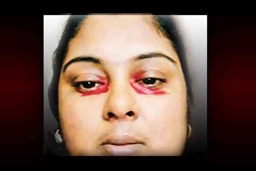 Kolkata’s SSKM hospital saves a woman with blood tears!