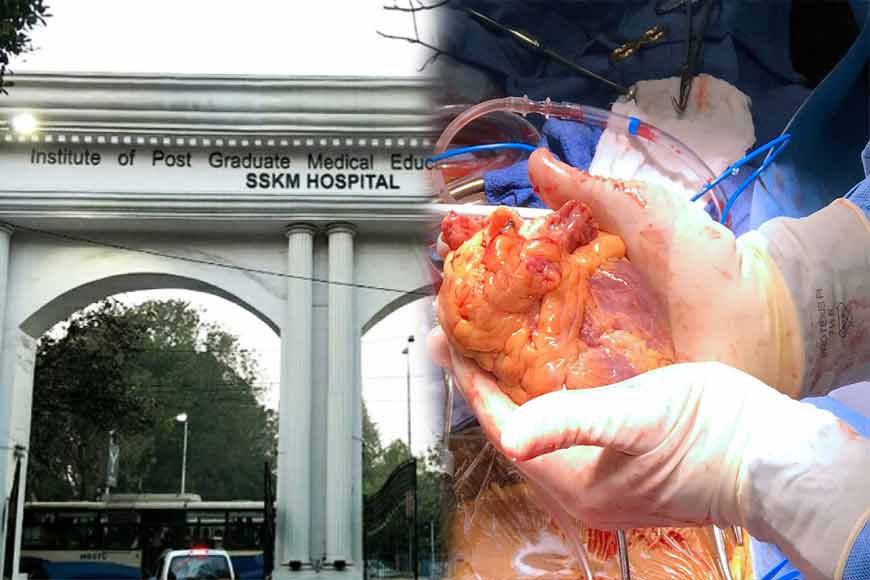 looking back Today SSKM Hospital created history with first heart transplant